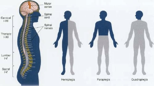 What Are the Four Types of Paralysis?